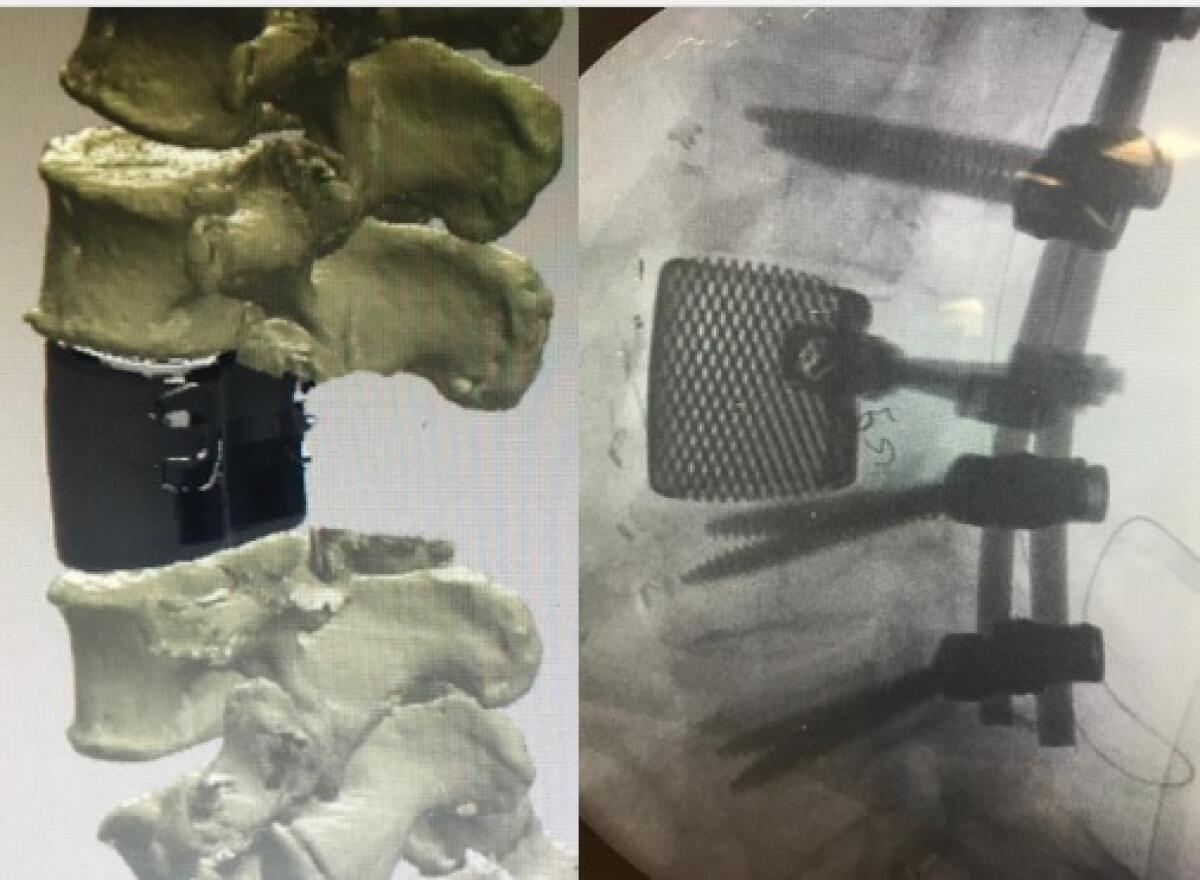 Pisa: impiantata vertebra stampata in 3D - Pisa: impiantata vertebra stampata in 3D
Credits: Aoup, Azienda Ospedaliero Universitaria Pisana