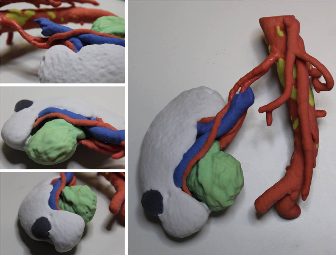 Modello in gesso per la resezione robotica di un tumore del rene. Il modello può essere utilizzato per pianificazione chirurgica e guida intra-operatoria. Credist: 3D4Med/ Università degli Studi di Pavia