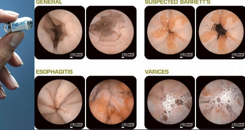 Diagnosi con videocapsula endoscopica PH:ziuaveche.ro