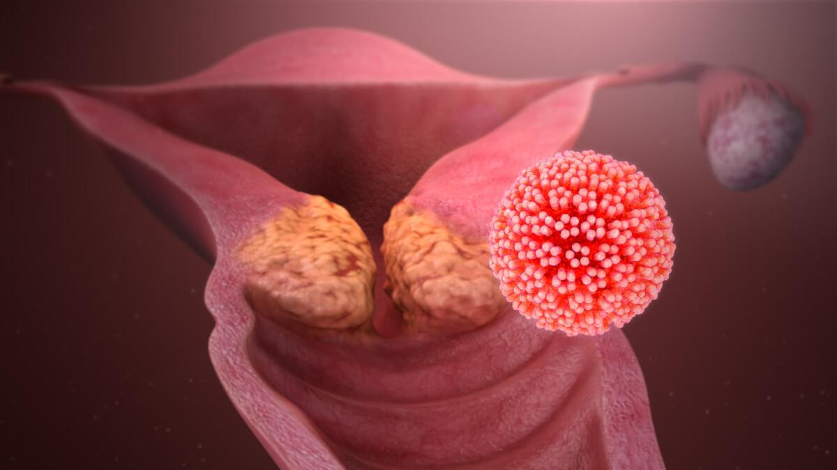 Cancro dell’utero: da Londra un nuovo test contro l’HPV - Ph. tuobenessere.it