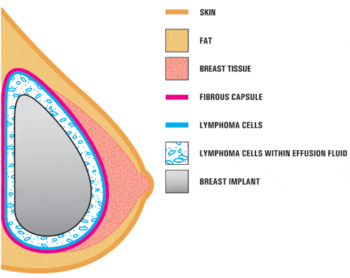 L'immagine mostra la presenza di cellule ALCL in prossimità di una protesi mammaria. Crediti: FDA