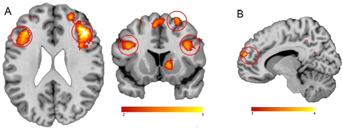 Acquisizioni della Corteccia Prefrontale Ventromediale nei pazienti affetti da narcolessia di tipo 1 durante il test, crediti: Nature