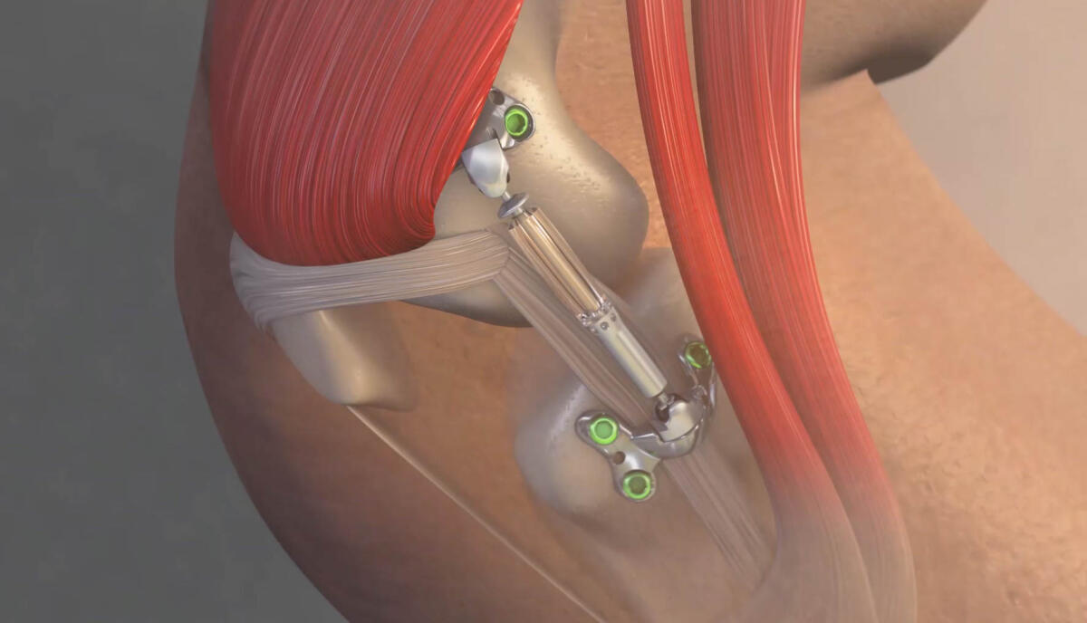 Negli Stati Uniti il primo impianto per assorbire il carico sul ginocchio - The Calypso Knee System, sviluppato da Moximed, Inc.