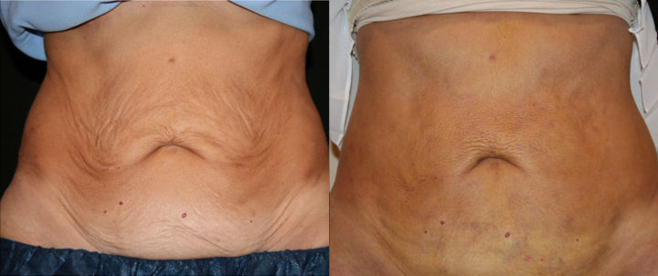 Before/ after : trattamento di rassodamento cutaneo subdermico con J Plasma                           PH: lookyounger.news