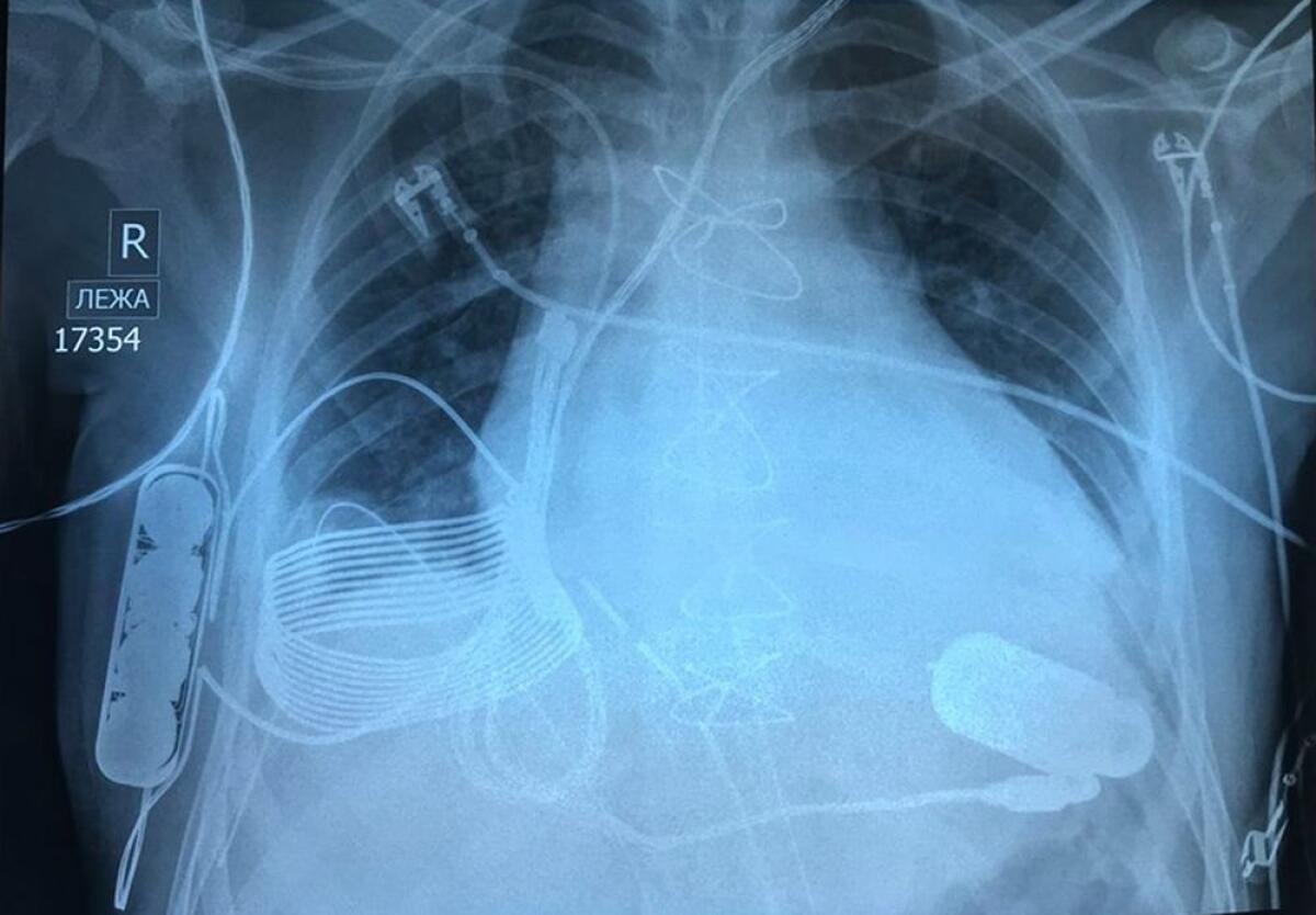 Impiantato il primo cuore artificiale che si ricarica dall'esterno - Impiantato il primo cuore artificiale che si ricarica dall'esterno
Credits:  Leviticus Cardio