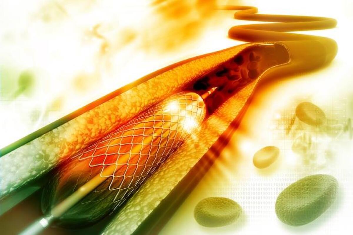 Impianto di stent eseguito con un robot: prima volta in Italia - Impianto di stent eseguito con un robot: prima volta in Italia
Credits: ANSA.it