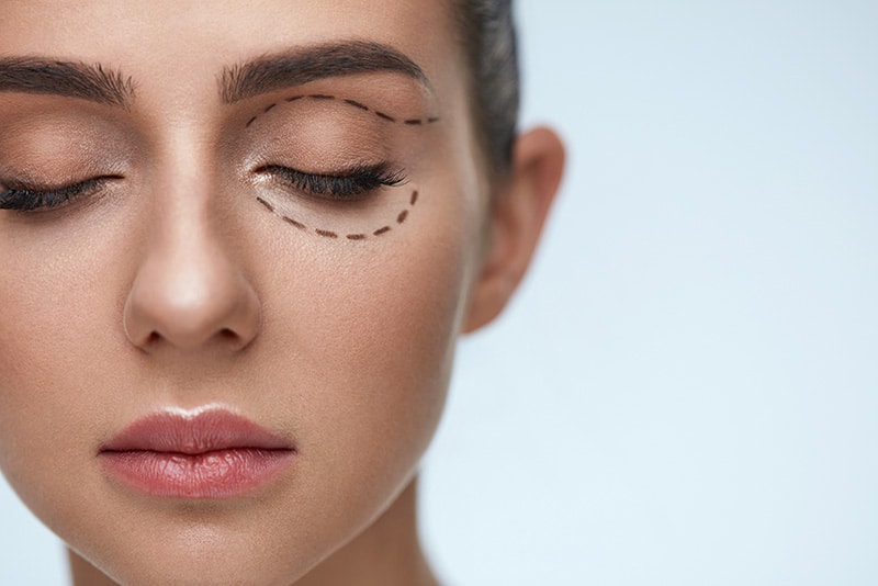 Plastic Surgery Operation. Closeup Beautiful Young Woman Face With Fresh Skin And Perfect Makeup On White Background. Female Face With Black Surgical Lines On Eyelids And Under Eyes. High Resolution