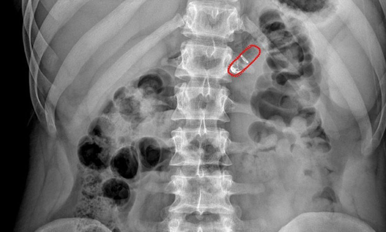 Questa radiografia radiografia mostra la pillola (evidenziata in rosso) durante il passaggio dallo stomaco all'intestinoCredits: Rani Therapeutics
