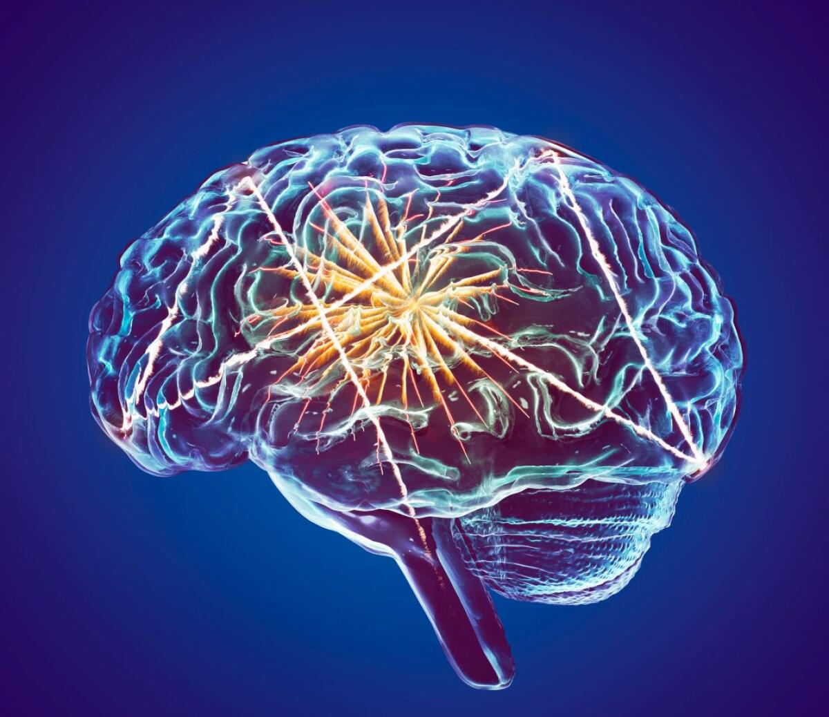 LATE: una forma di demenza che mima l’Alzheimer - © genengnews.com