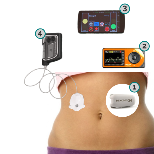 Schematizzazione dei componenti del pancreas artificialecredits: bussolasanita.it