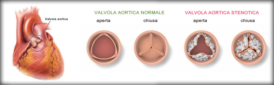 Confronto tra valvola aortica funzionante e stenoticacredits: telecolor.net
