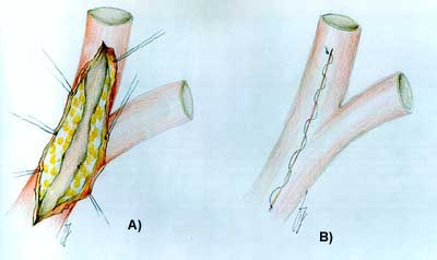 Esempio di sutura chirurgica su arteria cerebralecredits: fabiocolombo.it