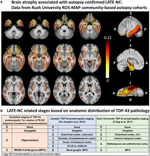 MRI eseguite post-mortem su pazienti affetti da LATE.©Brain