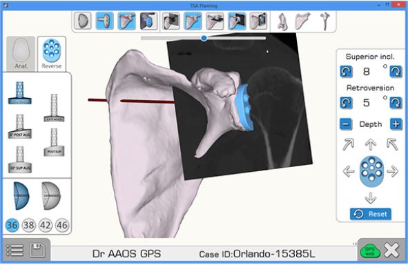 Creazione planning pre-operatorio per protesi spallaCredits: exac.com