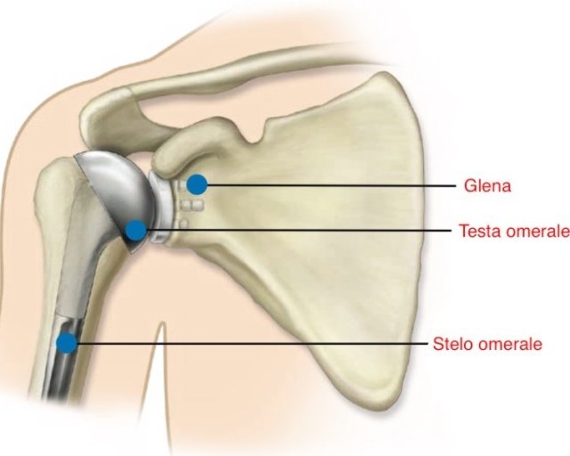 Schematizzazione protesi spalla con innesto nelle cavità glenoideaCredits: arthroteam.it