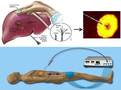 Schematizzazione termoablazione a radiofrequenze per rimozione tumoricredits: meciciitalia.it