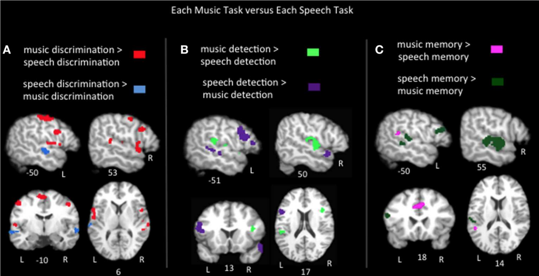 fMRI che mostrano dei modelli cerebrali. Credits: Arianna N. LaCroix, Alvaro F. Diaz and Corianne Rogalsky, Communication Neuroimaging and Neuroscience Laboratory, Department of Speech and Hearing Science, Arizona State University, Tempe, AZ, USA