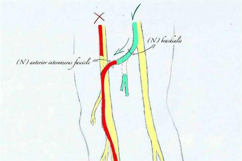 Collegamento nervi sani bypassando nervi lesionati della mano su paziente tetraplegicoCredits: avvenire.it