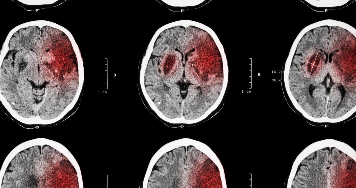 Infarto cerebrale: ridurre i danni agendo sul sistema immunitario - ©Texas Heart Institute