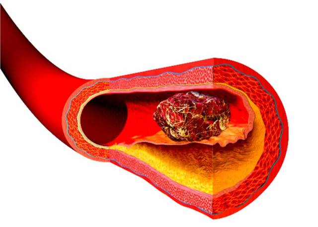 Aterosclerosi: quanto rischiamo? Ce lo dice la legge di Poiseuille