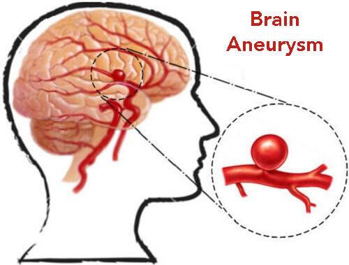 Aneurisma cerebraleImage credits: Natural Health News