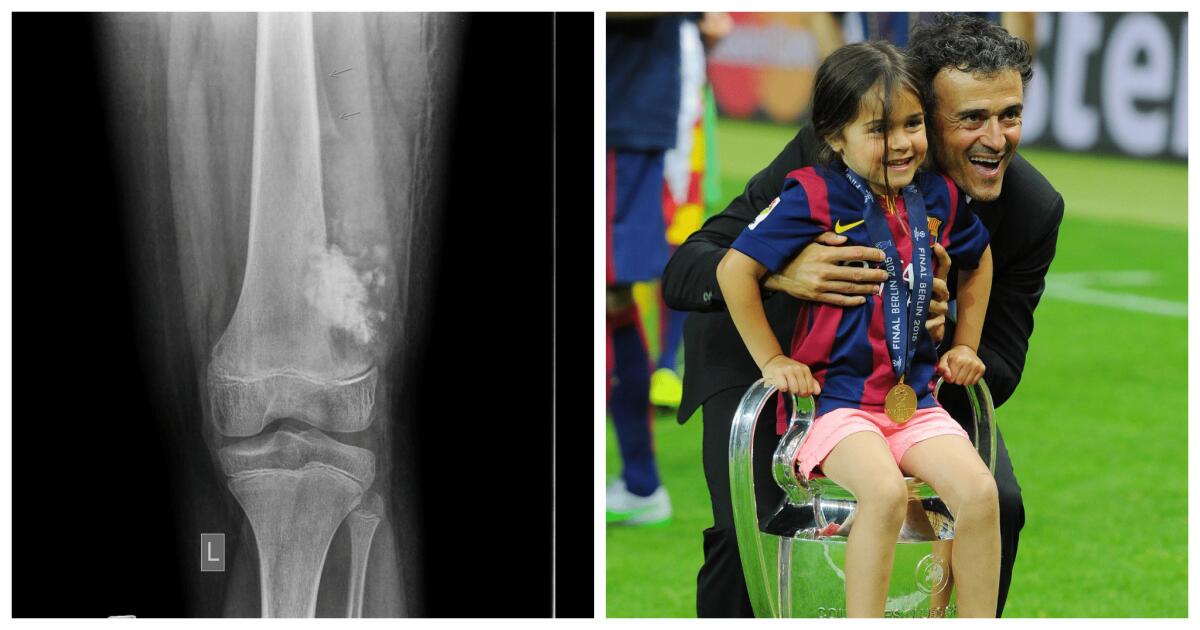 Cos'è l'osteosarcoma, la malattia che ha ucciso la figlia di Luis Enrique - 