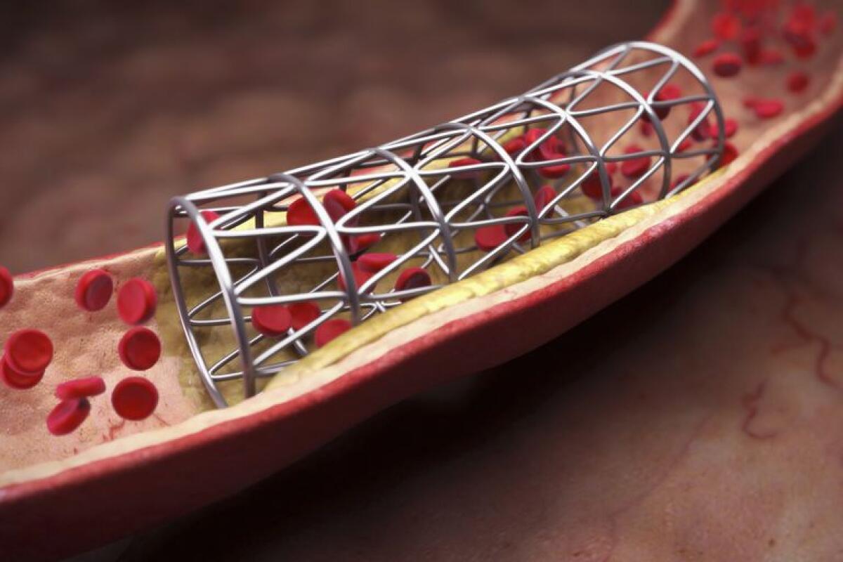 Zurigo: realizzati microstent stampati 3D in materiale a memoria di forma - microstent