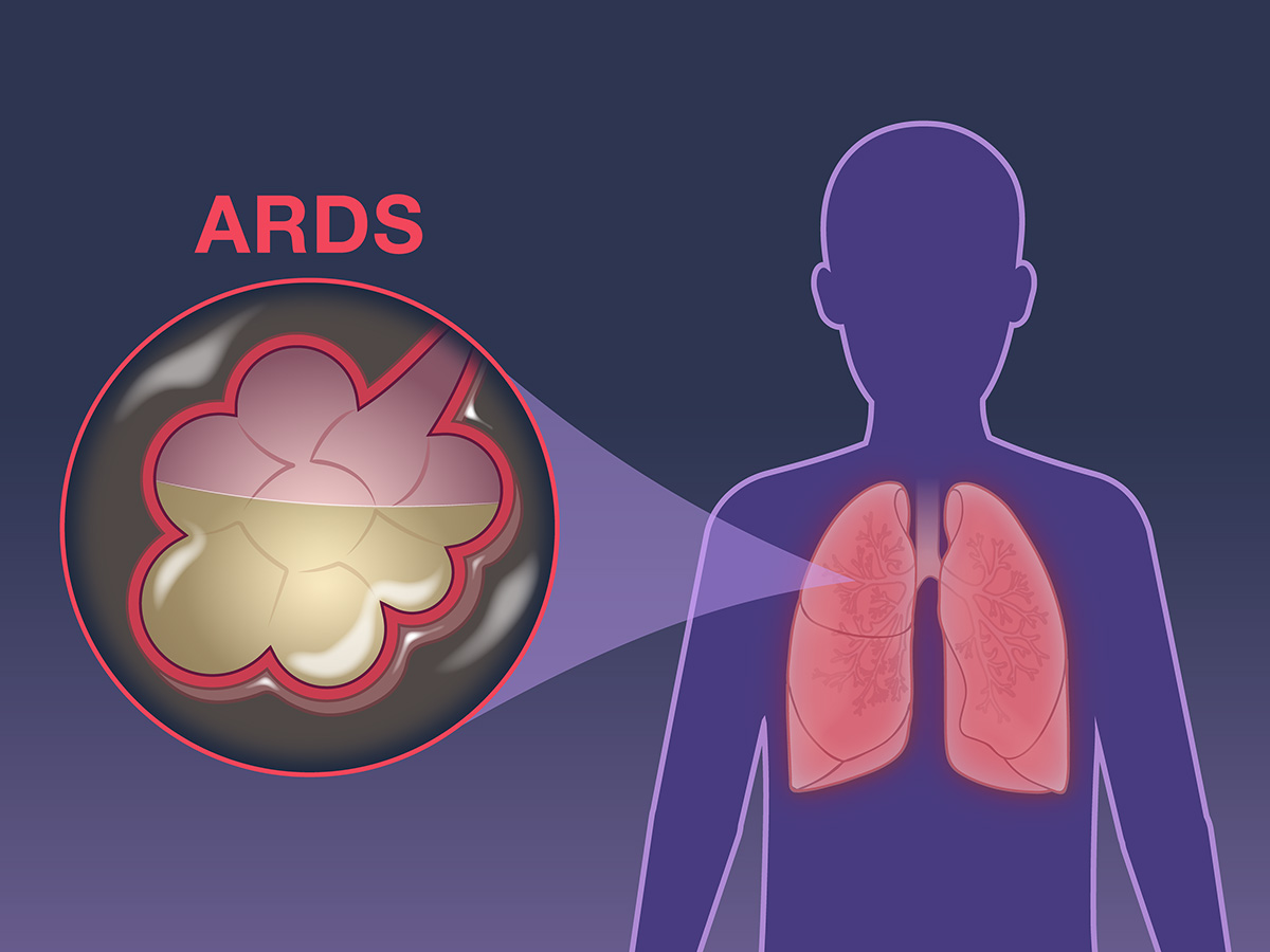 Alveoli pieni di liquidi in un soggetto affetto da sindrome da distress respiratorio acutocredits: nejm.org