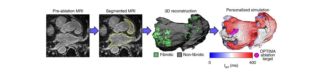 Ricostruzione personalizzata 3D del cuore mediante procedura OPTIMAcredits: nature.com