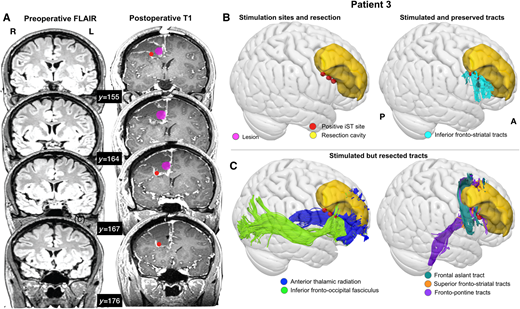 L'effetto della chirurgia sulla sostanza bianca. Esempio di un singolo paziente (Paziente 3) che mostra ( A ) la posizione dei siti di stimolazione (sfere rosse), il tumore e la cavità di resezione su sezioni coronali del FLAIR preoperatorio e T 1 ( B ) p