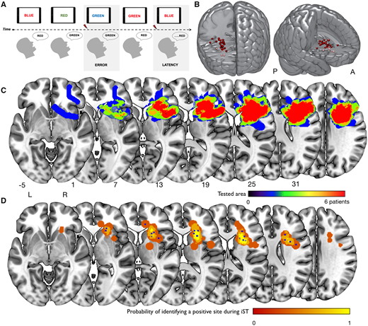 Procedura intraoperatoria e siti di stimolazione positiva. ( A ) Il corso del tempo dell'IST. Le frecce rosse indicano l'inizio della stimolazione. Riprodotto con il permesso di Puglisi et al. (2018) . ( B ) I singoli siti di stimolazione di 25 pazienti c
