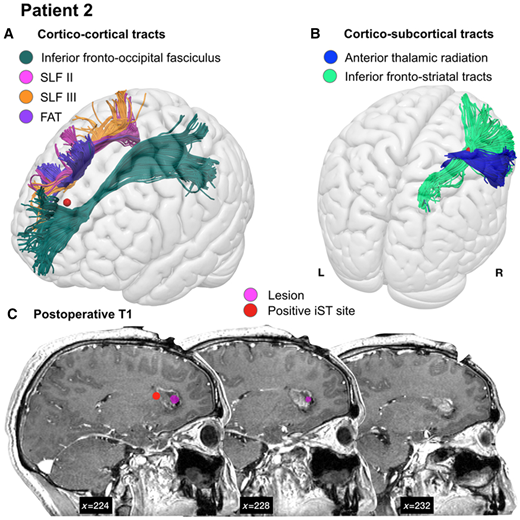 Vicinanza di tratti ai siti di stimolazione. Esempio di relazione tra un sito positivo per iST (rosso) e ( A ) i tratti di sostanza bianca cortico-corticale e ( B ) cortico-subcorticale nel paziente 2. L'anatomia del singolo paziente è stata registrata in