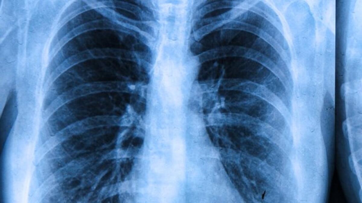 Fibrosi cistica: la FDA approva una nuova terapia - ©WATN