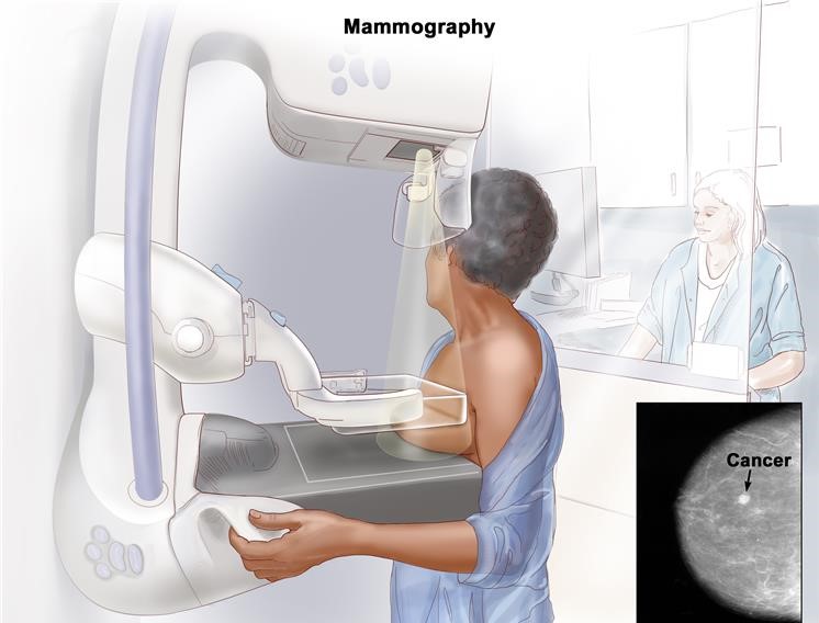 Schema mammografia per prevenzione tumore al seno credits: cancer.gov