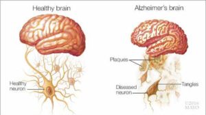 Differenza sistema nervoso sano (sinistra) e affetto da Alzheimer (destra).