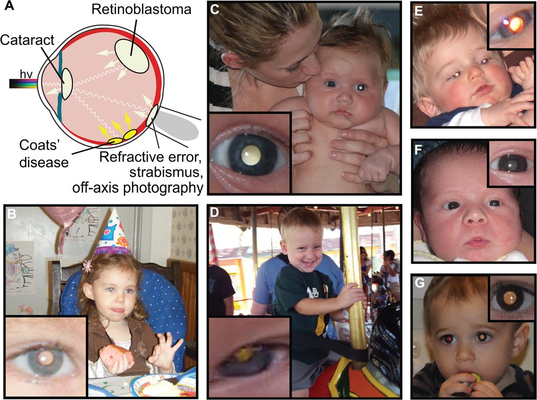Esempi di leucocoria patologica in bambini affetti da (B) ipermetropia, (C) retinoblastoma, (D) malattia di Coats, (E) ambliopia e (F) cataratta, confrontati con (G) il riflesso rosso e leucocoria fisiologica in un bambino sano. Crediti: Articolo: Munson 