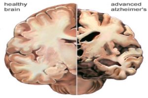 Differenze cervello sano (sinistra) e cervello affetto da Alzheimer (destra).