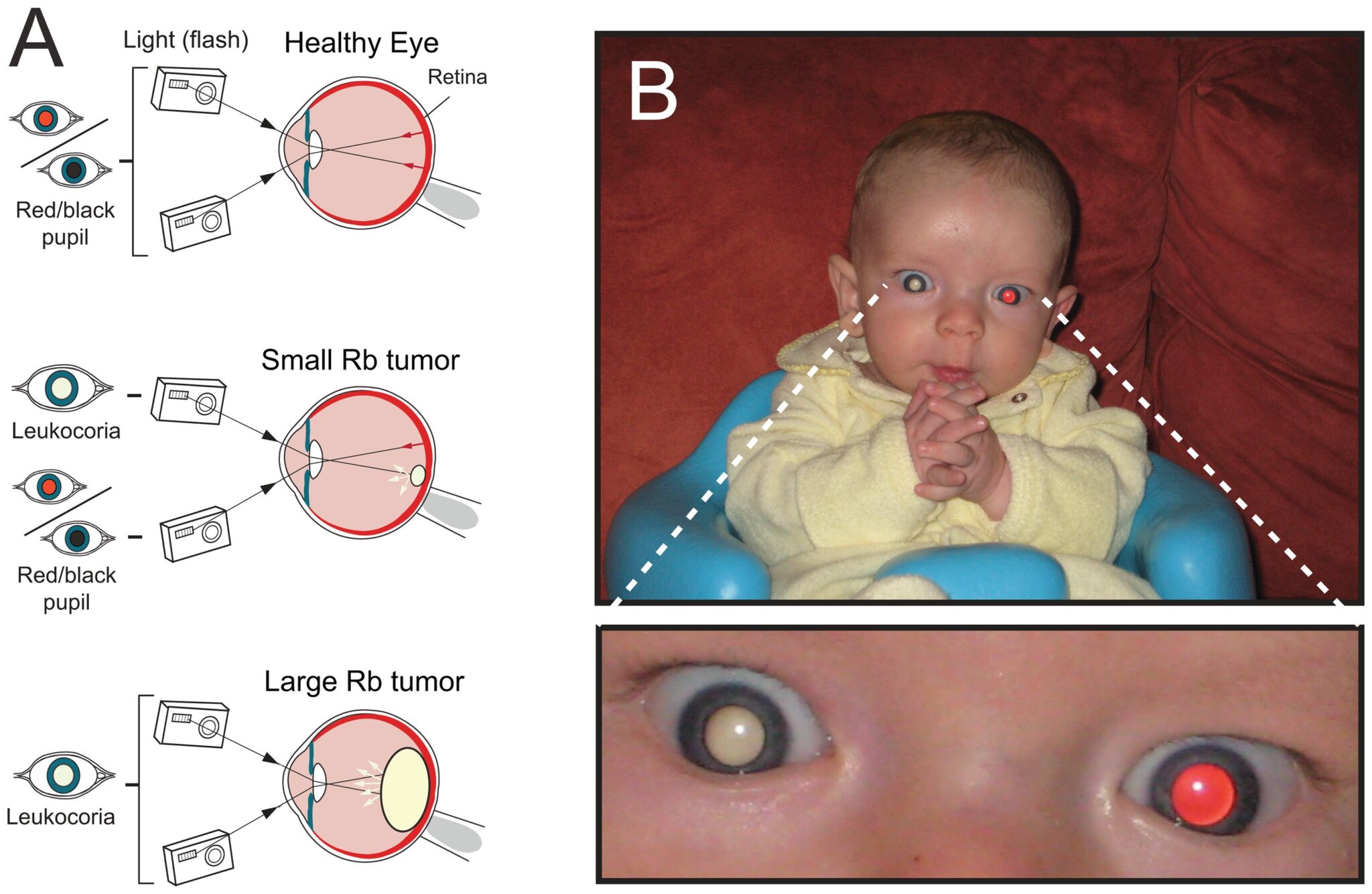 Esempio di malattie agli occhi dei bambini. Crediti: Abdolvahabi A, Taylor BW, Holden RL, Shaw EV, Kentsis A, Rodriguez-Galindo C, et al. (2013) Colorimetric and Longitudinal Analysis of Leukocoria in Recreational Photographs of Children with Retinoblasto