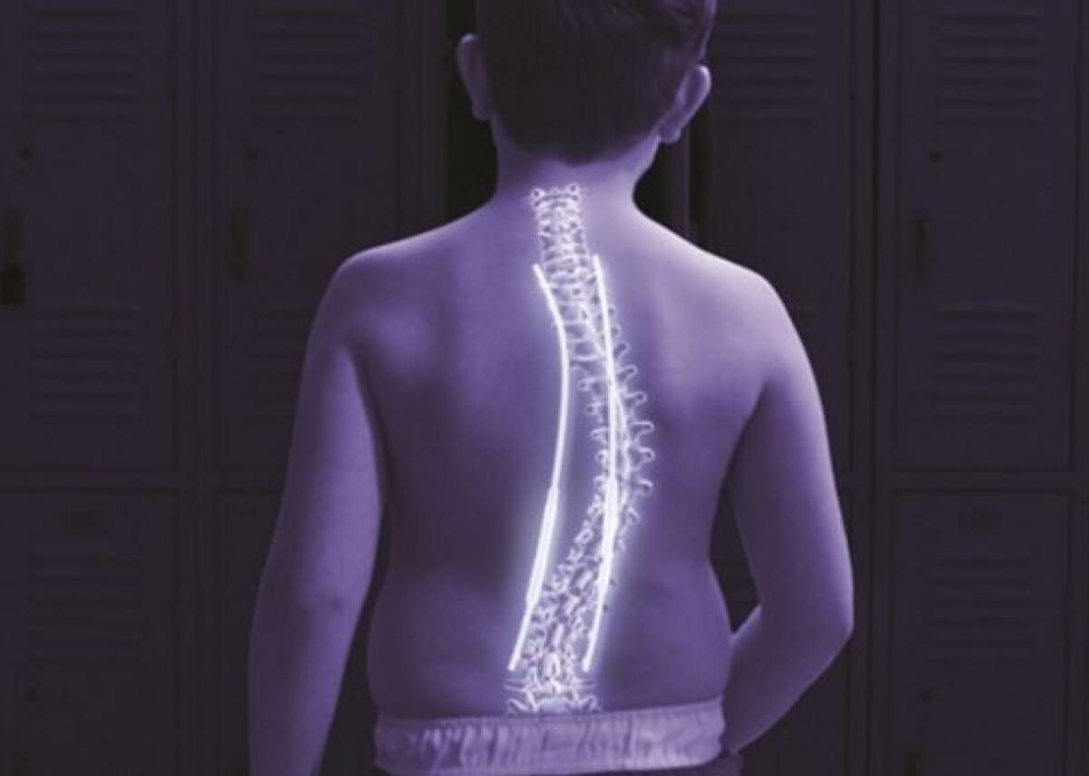 Roma: barre magnetiche per correggere scoliosi estrema di 116° - Impianto barre magnetiche per correggere scoliosi estrema di 116° su bambino a Roma
credits: virtualblognews.altervista.org