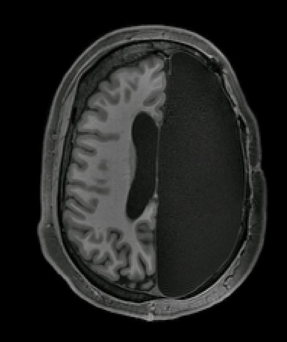 fMRI di un adulto a cui è stato rimosso un intero emisfero - crediti: © Caltech Brain Imaging Center