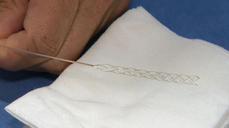 Stent metallicoCredits: Mark Bochsler/CBC