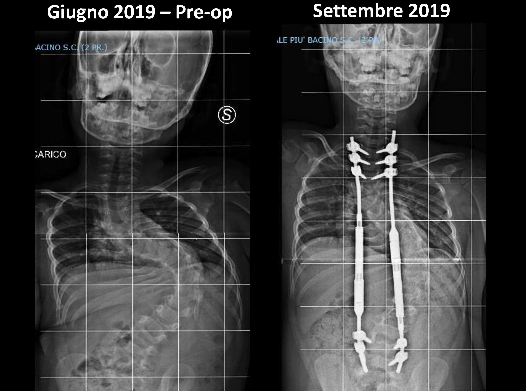 Confronto tra immagine pre-operatoria e dopo 4 mesi dall'interventocredits: ospedalebambinogesu.it