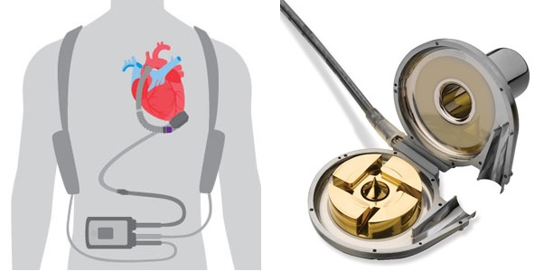 A sinistra HeartMate 3 Left Ventricular Assist Device della Abbott, a destra HVAD Left ventricular Assist Device della HeartWare