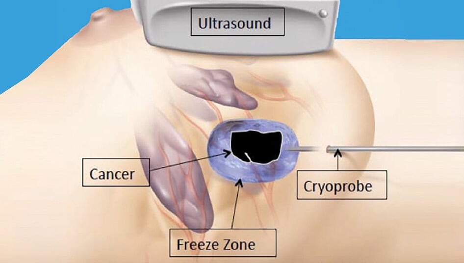 Credits: Interventional News