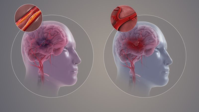 Le due forme di ictus: a sinistra l'ictus ischemico e a destra l'ictus emorragico. Credits:  https://www.scientificanimations.com/