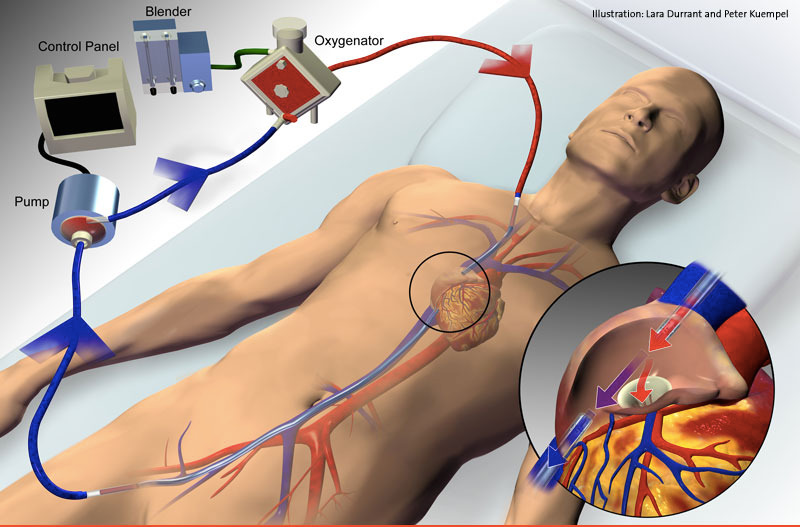 Schematizzazione circuito di ECMO. Credits: pazienti.it