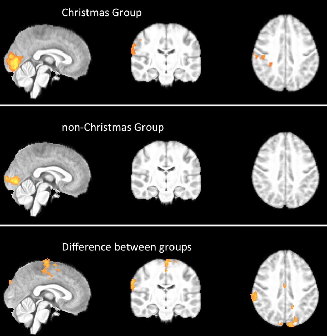 L'immagine, tratta dal British Medical Journal, mostra la diversa attivazione cerebrale dei due gruppi
