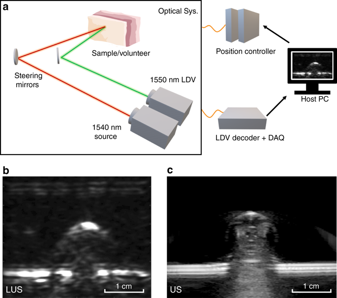 Full noncontact laser ultrasound: first human data. Light: Science & Applications