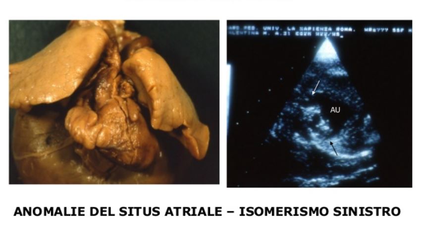 Ricostruzione ed ecografia cuore in soggetto affetto da isomerismo sinistro.credits: prof.ssa Flavia Ventriglia