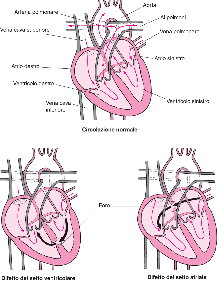 Confronto tra circolazione normale e con canale atrio-ventricolare.Credits: msdmanuals.com